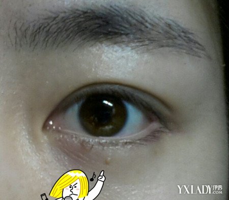【图】眼皮长了个小肉粒切莫大意这三种情九游娱乐况